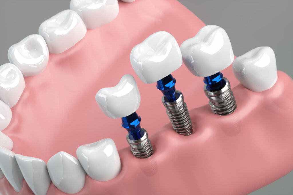 EMS美顔器はインプラントや歯列矯正ワイヤーの治療中でも使えるの？